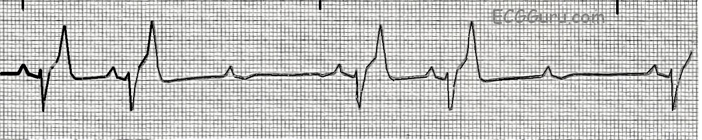 ecg-basics-second-degree-av-block-type-ii-ecg-guru-instructor